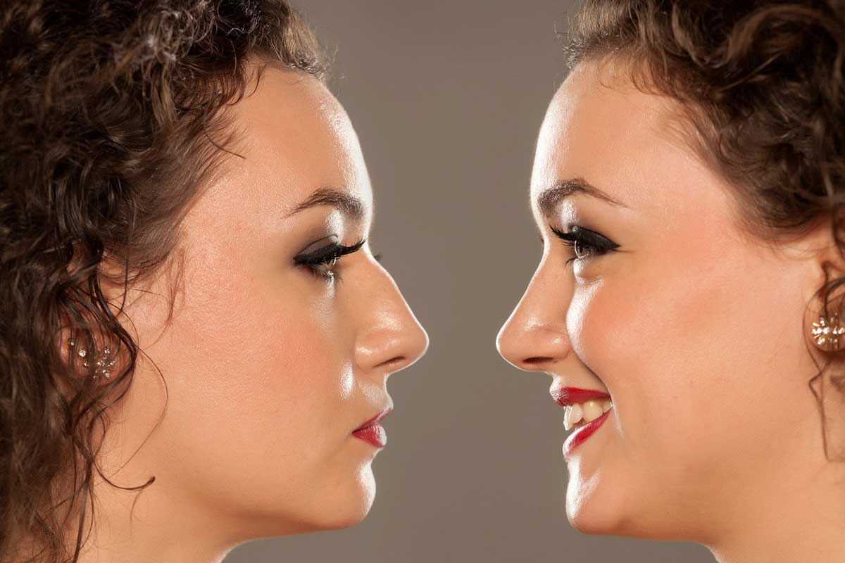 تجميل الأنف