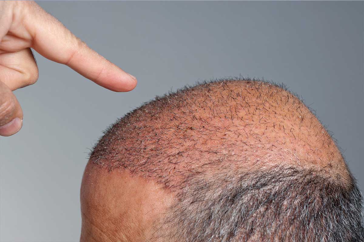 زراعة الشعر بتقنية DHI