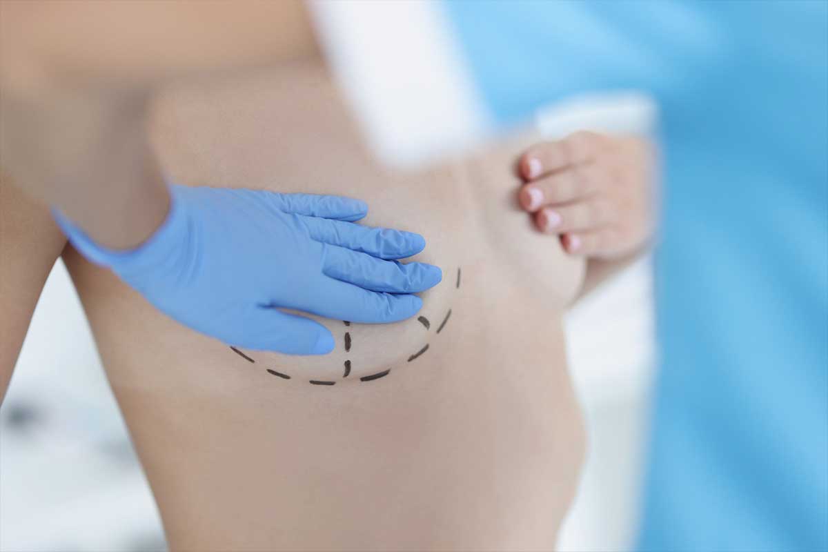 Breast Uplift-Boob Lift-Mastopexy-Antalya Aesthetics Doctor