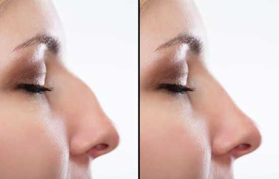 Rhinoplasty