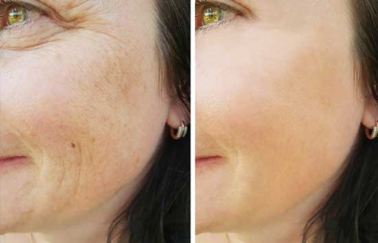 skin-rejuvenation